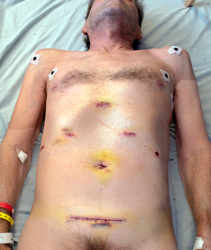 Notion Liver surgery